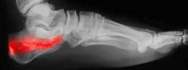 fracture de fatigue