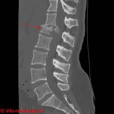 fracture rachis
