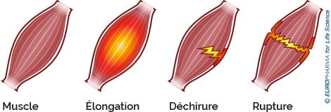 déchirure musculaire