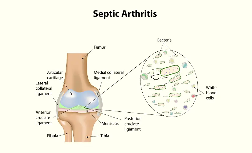 infection articulaire