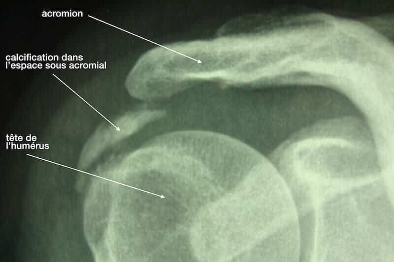 Calcification espace sous-acromial sous radio