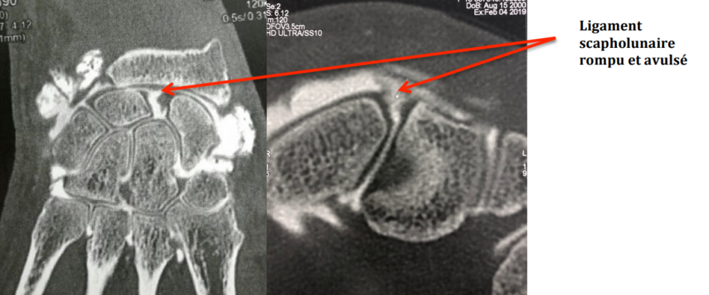 IRM rupture du ligament scapho-lunaire