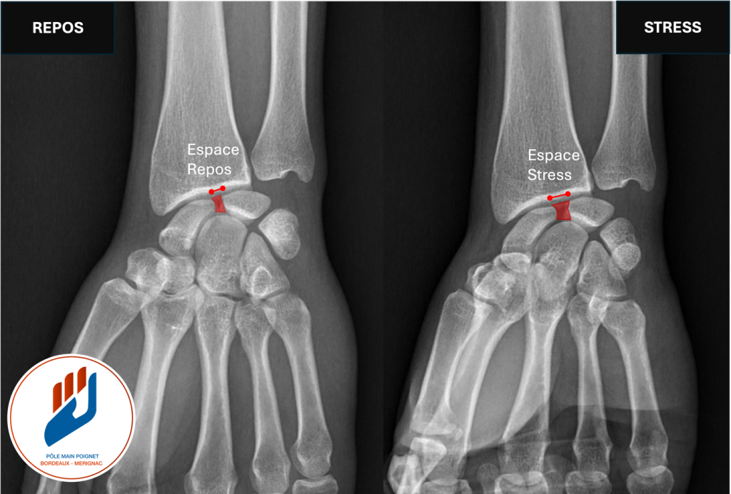 radiographie dynamique objectivant une lésion du scapho-lunaire