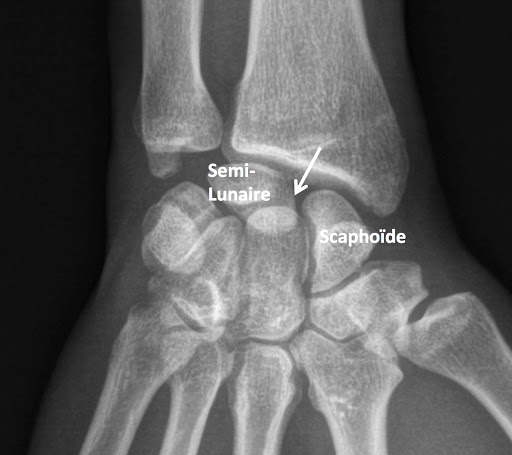 rupture ligaments poignet sous radio
