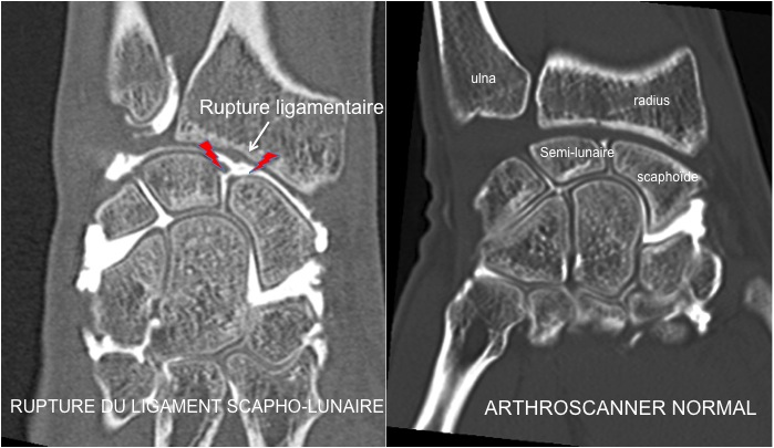 Arthroscanner sous injection objectivant une rupture du ligament scapho-lunaire.