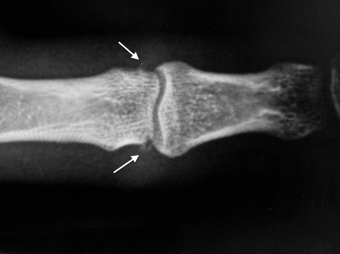 Entorse interphalangienne proximale sous radiographie 