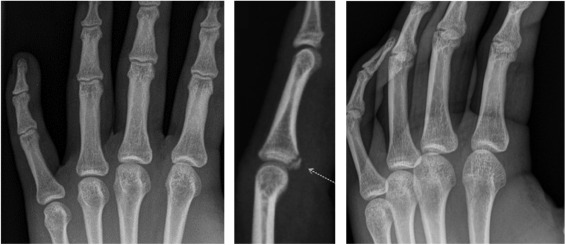 Entorse articulations interphalangiennes proximales sous radiographie 