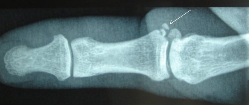Radiographie entorse métacarpo-phalangienne du pouce