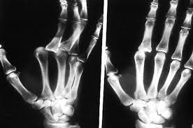 Radiographie entorse métacarpo-phalangienne des doigts longs 