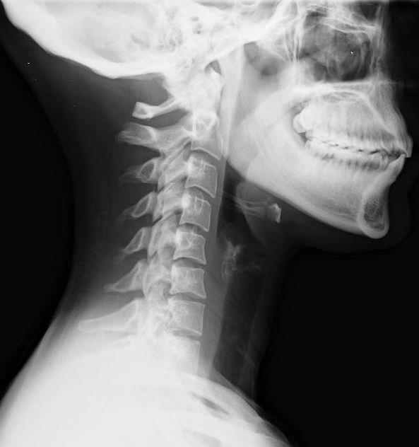 radiographie entorse cervicale