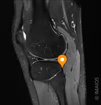 IRM Tendon poplité