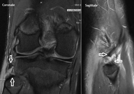 Rupture distale biceps fémoral sous irm 