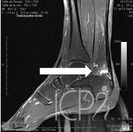 tendinopathie du tendon d'achille sous irm