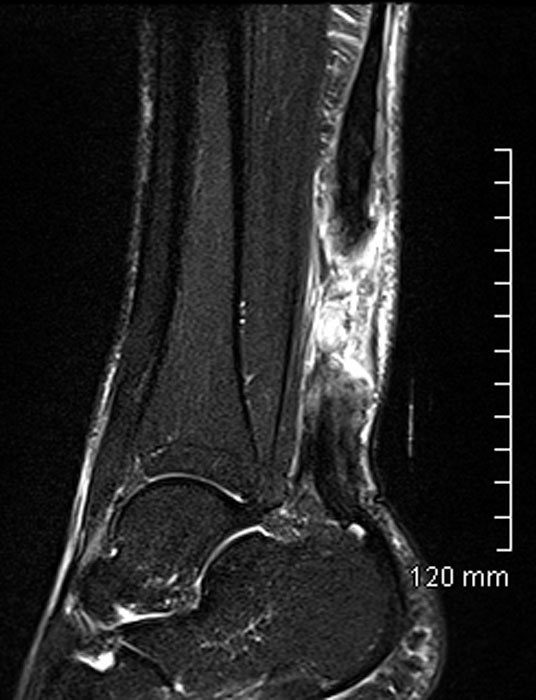 Rupture tendon d'achille sous IRM