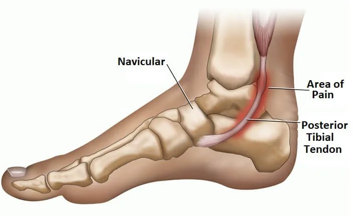 Tendinopathie du tibial postérieur 