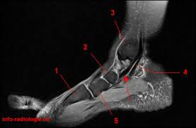 Tendon tibial postérieur sous IRM