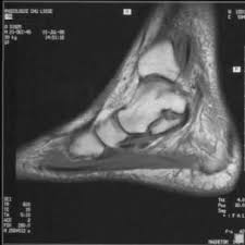 IRM rupture tendon tibial postérieur
