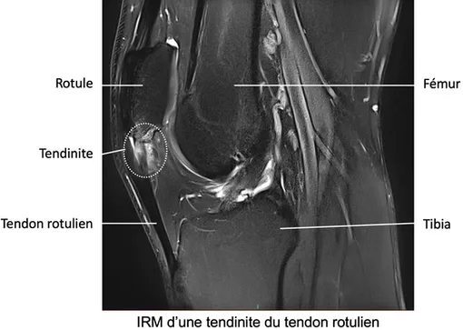 IRM tendinite du tendon rotulien 