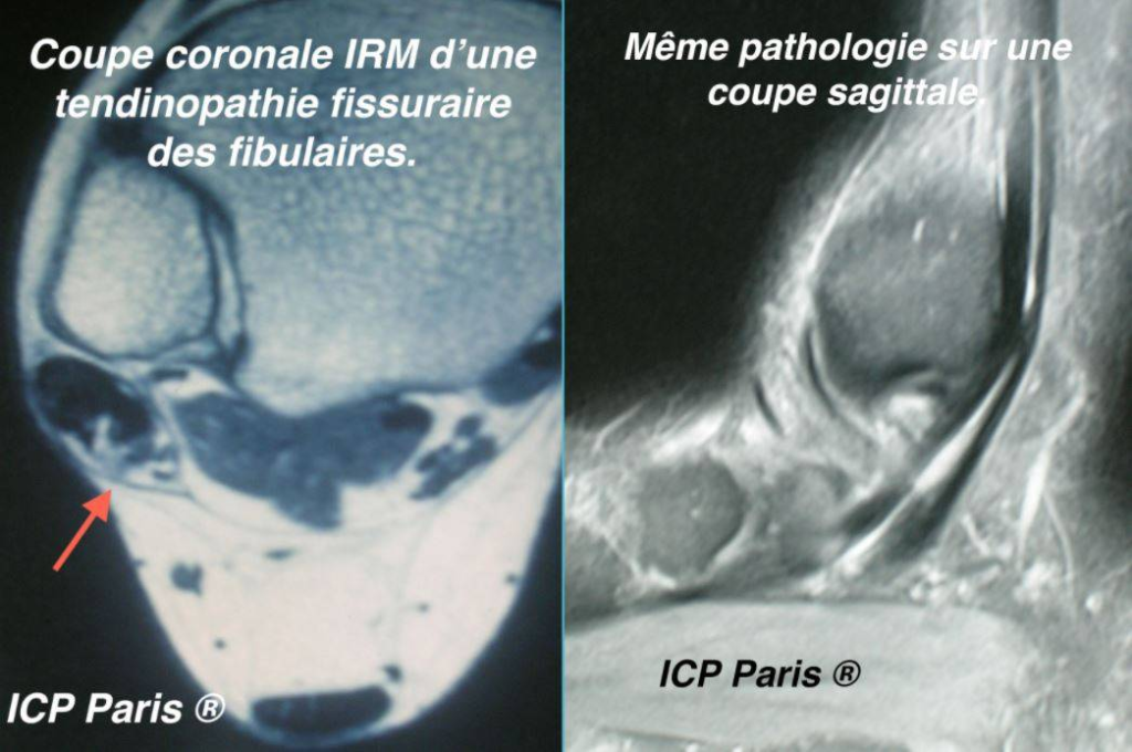 IRM Tendinopathie des tendons fibulaires