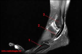 Tendons fibulaires cheville sous IRM