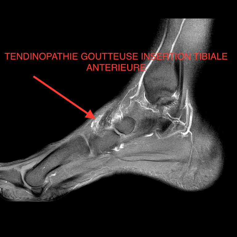 IRM Tendinopathie tibial antérieur 