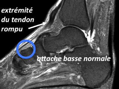 IRM Rupture du tendon tibial antérieur 