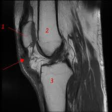 IRM rupture tendon patellaire 