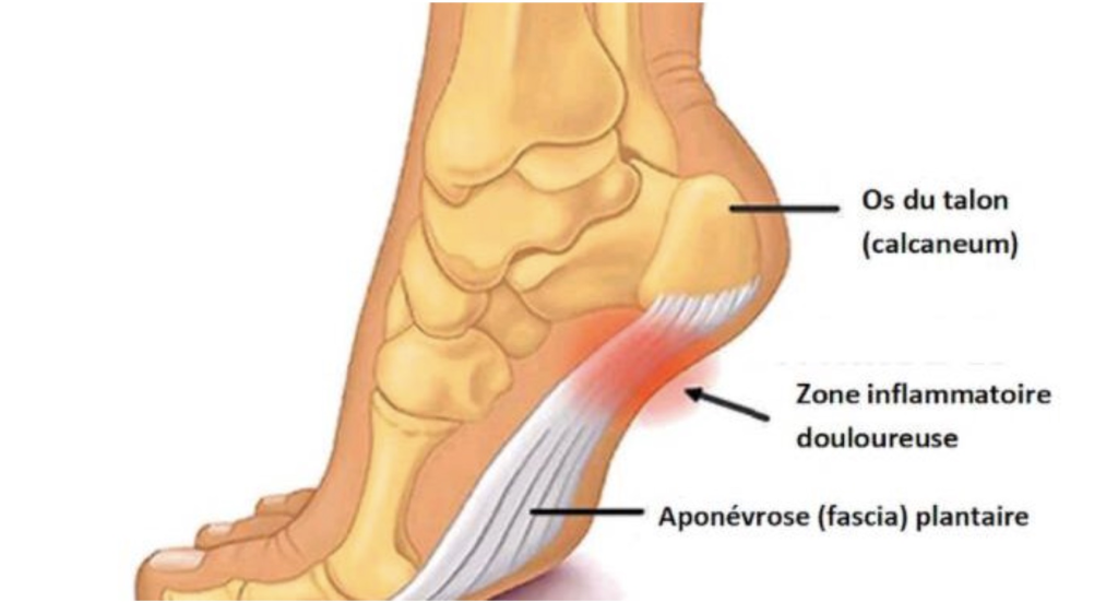 Anatomie de l'aponévrose plantaire