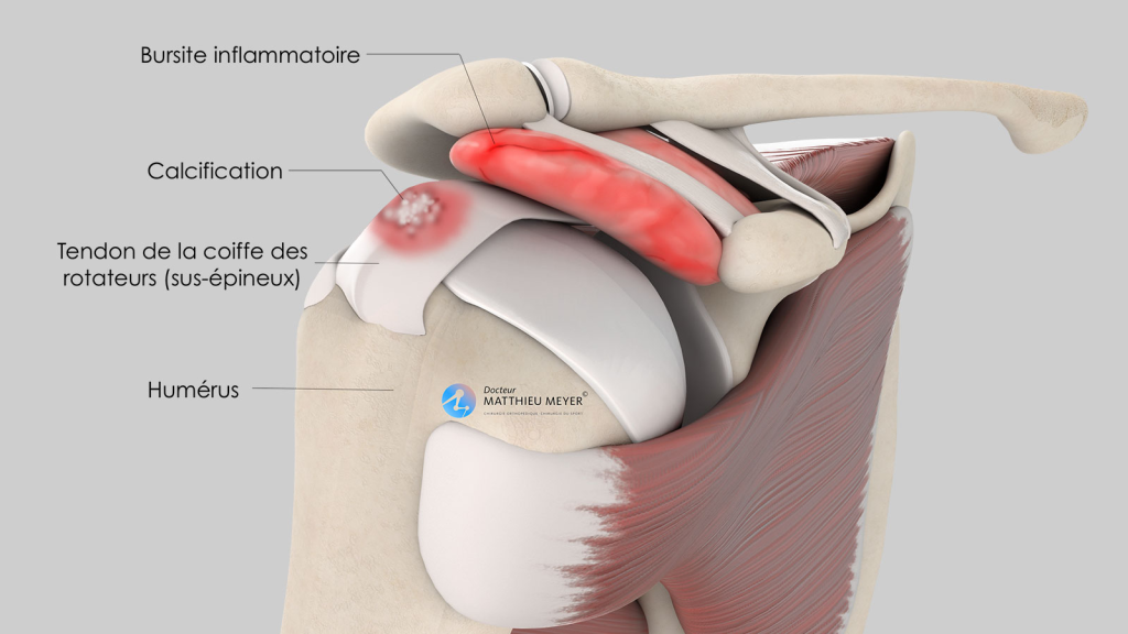 Tendinopathie calcifiante
