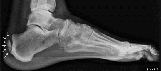 Entésopathie calcifiante sous radiographie