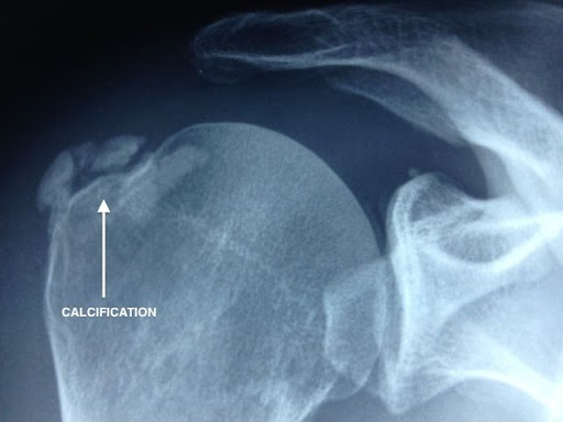 Tendinopathie calcifiante épaule sous radiographie