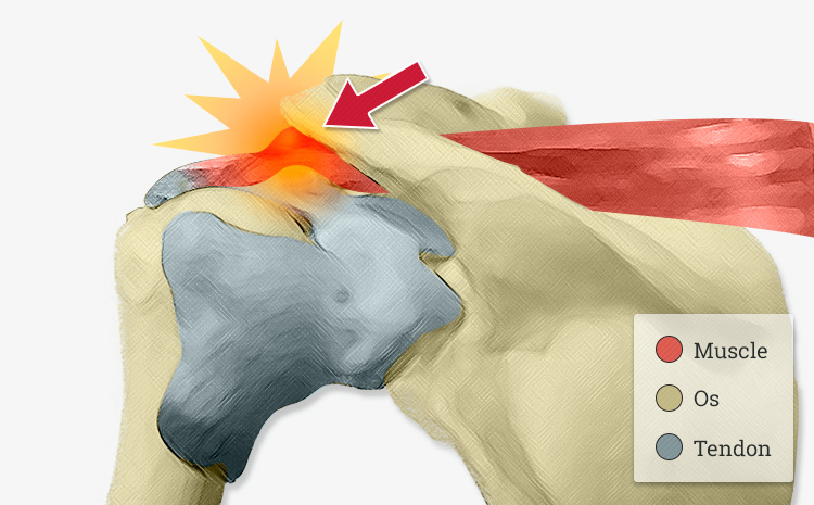 tendinopathie chronique