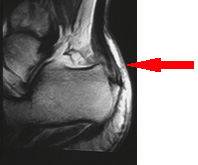 Tendinopathie chronique du tendon d'achille