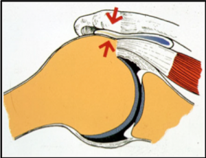 Tendinopathie dégénérative