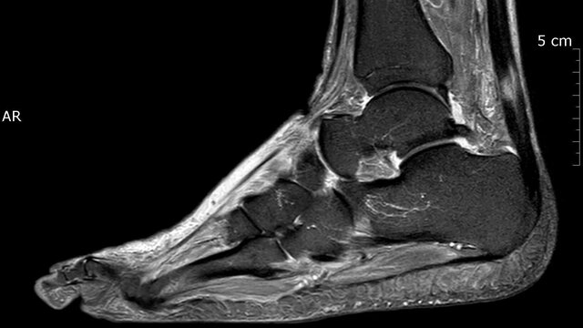 Tendinopathie dégénérative 