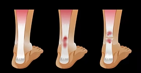 Rupture partielle tendon d'achille