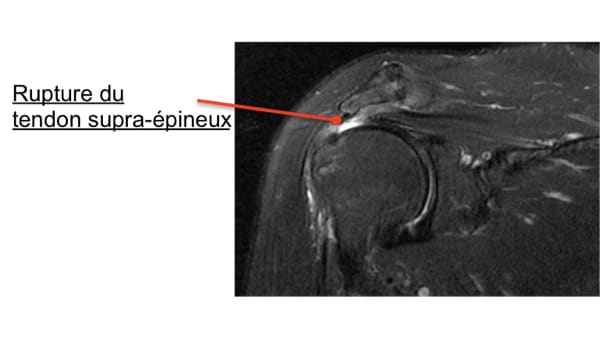 Rupture du tendon supra-épineux sous IRM