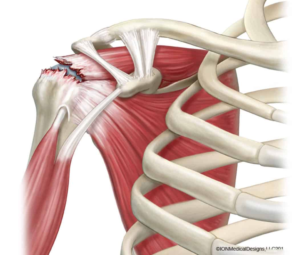 Rupture totale du supra-épineux