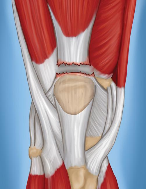 Rupture totale du tendon quadricipital