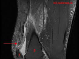 Rupture totale du tendon quadricipital sous IRM