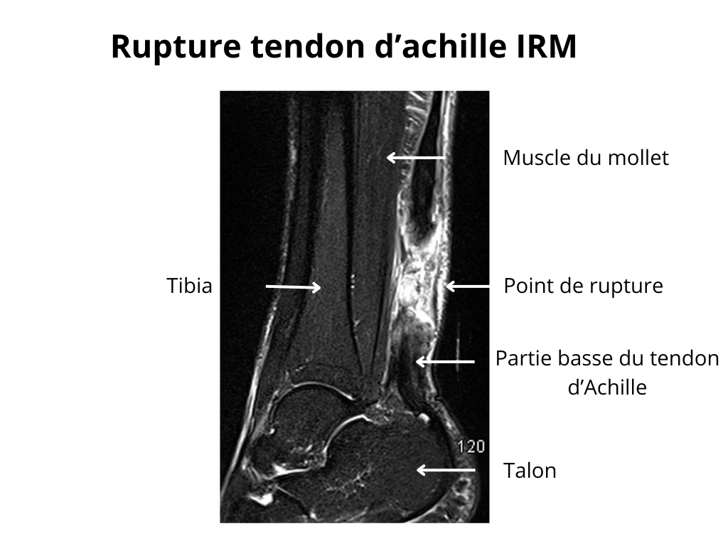 Rupture du tendon d'achille sous IRM