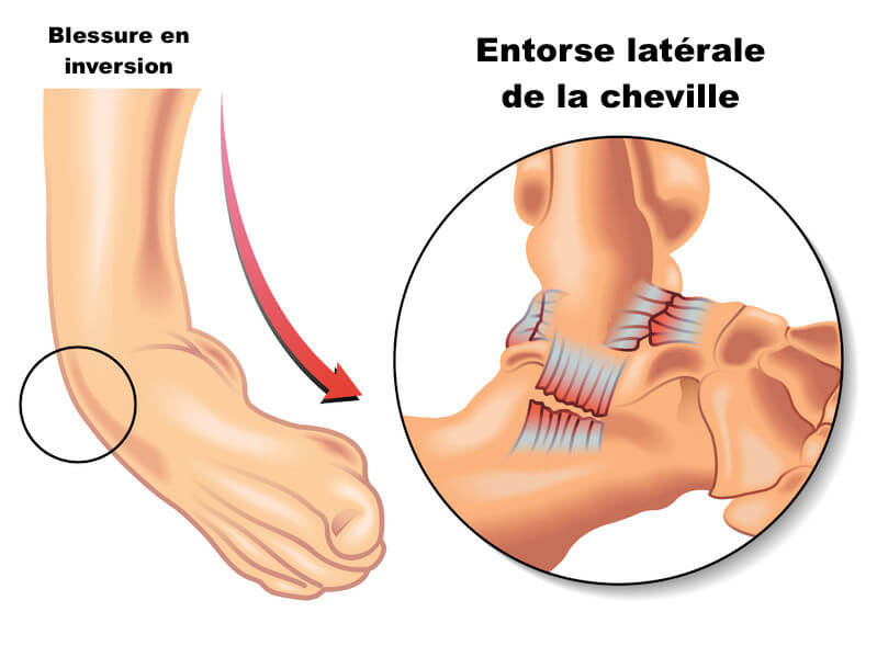 anatomie ligaments latéraux cheville