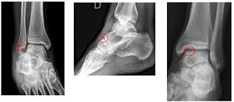 Radiographie cheville entorse ligaments latéraux 