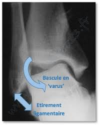 Radiographie cheville entorse ligaments latéraux 