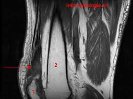 irm rupture tendon quadricipital
