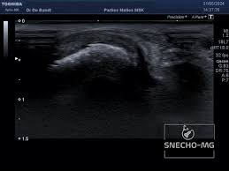 Exemple d'échographie objectivant un ligament calcanéo-fibulaire normal