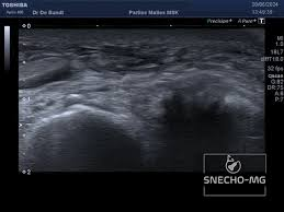 Exemple d'échographie objectivant une rupture du ligament calcanéo-fibulaire