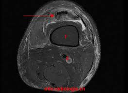 IRM rupture tendon quadricipital 