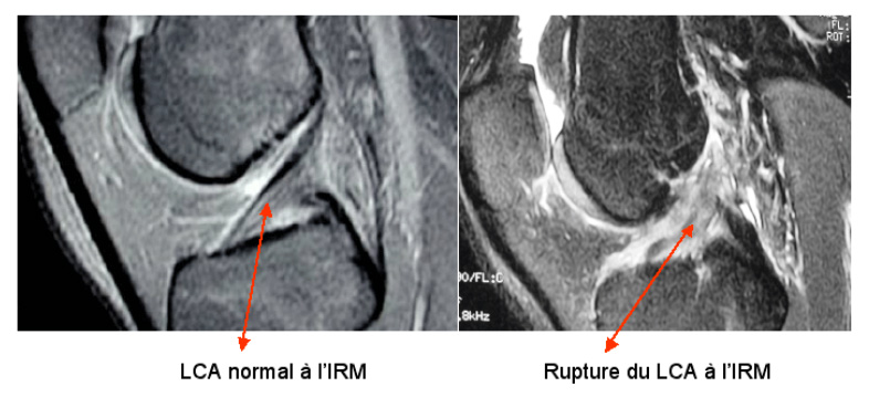 IRM rupture du LCA sous IRM