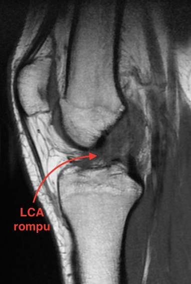 Rupture LCA sous IRM